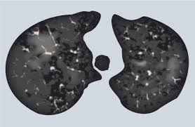 The illnesses are caused by other unregulated chemicals and pesticides they are cutting the thc oil with. Vaping A Review