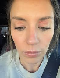 My eyelids started cracking with these red lines it's hard to keep my eyes  open .. What is this ☹️