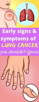 To better protect yourself against lung cancer, get informed on the following early warning signs… Pin On No Limit Advertising