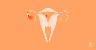Apr 10, 2018 · spotting, or staining (doctors use the terms interchangeably), is a small amount of vaginal bleeding one to three days before a period, according to brightman. Ovulation Bleeding And Ovulation Spotting What It Is Why It Happens
