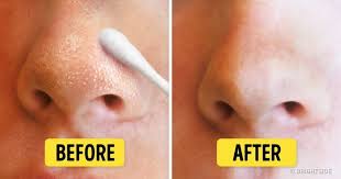 8 Natural Ways To Get Rid Of Blackheads And Whiteheads Fast How To Get Rid Of Acne How To Get Rid Of Pimples Get Rid Of Blackheads