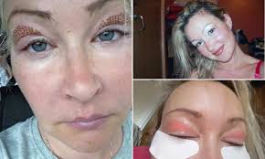 We did not find results for: Mother Of Seven 40 Is Left With Permanent Pink And Crusty Eyelids After A Botched Eye Lift Daily Mail Online