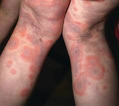 Image result for Erythema Multiforme Major