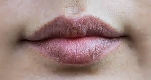 Apply lemon juice around the mouth and lips, over the dark skin and gently rub it. How To Get Rid Of Dark Lips Kobo Guide