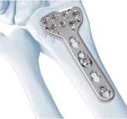 LCP Distal Radius System (2.4 mm)| Products | DePuy Synthes