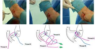 Maybe you would like to learn more about one of these? Arthroscopic Ankle Lateral Ligament Repair Alone Versus Arthroscopic Ankle Lateral Ligament Repair With Reinforcement By Inferior Extensor Retinaculum Springerlink