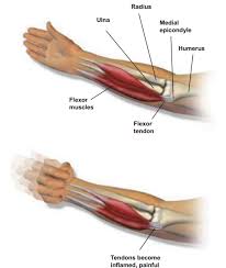 The combination of firm palpation over the medial epicondyle and resisted flexion will likely elicit a familiar pain experienced by the patient over the medial epicondyle. Medial Epicondylitis Advanced Health Solutions Woodstock