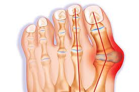 Pain caused by cancer that has spread to other places in the body. Bunion Pictures Causes Treatments