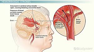 hemorrhagic stroke survival rate life expectancy recovery