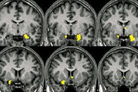 From your brain mri scan, doctors can understand whether you've had a stroke or have vascular dementia, or both. Mri Brain Scans Train Machines To See The World More Like Us New Scientist