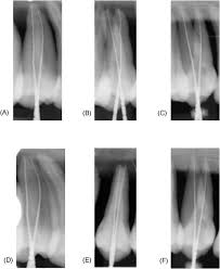 We did not find results for: An Efficacious Horizontal Angulation Separated Radiographically Superimposed Canals In Upper Premolars With Different Root Morphologies Sciencedirect