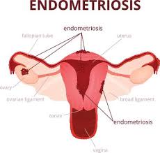 No one knows exactly how endometriosis might cause infertility. Endometriosis The American Pregancy Association