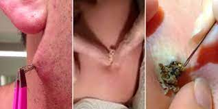 Pimple popper demonstrates how to remove an ingrown hair online, article, story, explanation, suggestion, youtube. This Is Why You Can T Stop Watching Those Zit Popping Videos