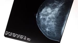 This means mammography correctly identifies about 87 percent of women who truly have breast cancer. Annual Over Biennial Mammograms Linked To Less Advanced Breast Cancer
