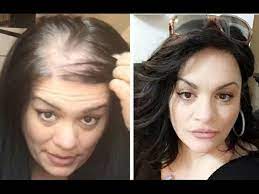 Recommendation for disguising thinning hair during menopause if you're experiencing hair loss, ask your doctor about testing for thyroid dysfunction. How To Hide Thin Balding Head With Hair Topper Uniwigs Youtube