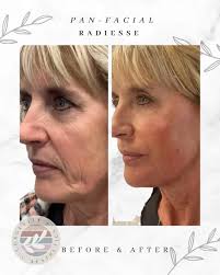 BOOM!! #💥 , look at this lovely woman!!! , yes!! , Check out this  pan-facial with Radiesse!! Yes you probably have seen her before because  she’s been dedicated to her aesthetic journey and these are ...