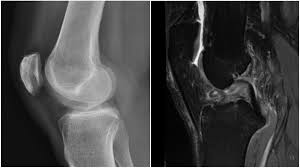 Examenului clinic unde pacientul prezinte dureri la testele speciale de stres ale meniscurilor atunci cand este prezenta o ruptura de menisc. Ce Trebuie SÄƒ Stim Despre Ruptura De Ligament IncruciÈ™at Popescu Dragos Chirurgia Genunchiului Si A Cartilajului Bucuresti