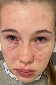 Stevens-Johnson syndrome/toxic epidermal necrolysis: initial assessment