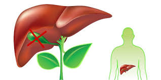 Things You Must Know If You Don T Have A Gallbladder Gallbladder Removal Diet Liver Detox Gallbladder