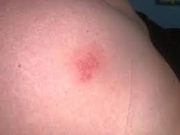 Find pictures of herpes, gonorrhea, and more. Does This Look Like Herpes Pics Genital Herpes Simplex Forums Patient