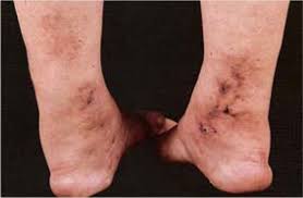 Image result for liver spots on legs