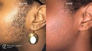 Laser removal of facial hair may be available on the nhs in some parts of the uk. Pcos Laser Hair Removal Excessive Hair Growth Youtube