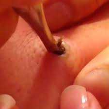 Go to nbcnews.com for breaking news, videos, and the latest top stories in world news, business, politics, health and pop culture. Can You Stomach Watching This 25 Year Old Giant Blackhead Being Removed Mirror Online
