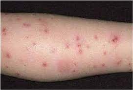 Typically, bites tend to occur on treatment. Insect Bites What Bit Me Phoenix Pest Control