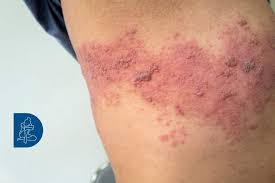 Image result for Varicella zoster on human skin