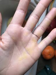 Antifungal medicines in the form of creams, tablets and shamoos can be used to treat pityriasis versicolour. Yellow On Hands Like Highlighter Except It S Not Health Ketogenic Forums