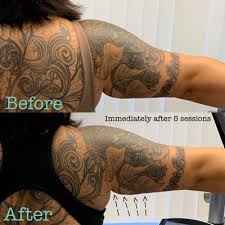 Three little circles tattoo on the right forearm. Bodyfx Underarm Fat 30 Y O Mixed Female Tattoos Review