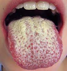 Homemade Tattoo Removal Cream Get Rid Inner Lip Tattoo