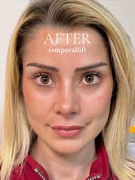 Fox Eye Temporal Lift Fully Healed