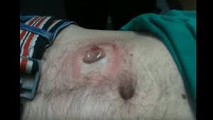 Hair follicles can be damaged by: Ingrown Hair Or Staph Infection