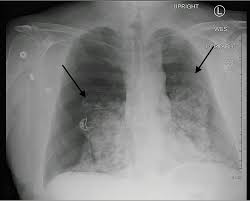 Image result for Open Pneumothorax