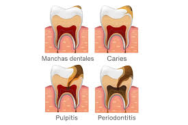 Image result for Pulpitis