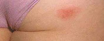 Hsv 2 virus is a type of hsv simple known as herpes simplex 2. Clinical Presentations Of How Hsv 1 Hsv 2 Can Present