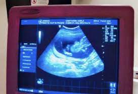 Ultrasonido 14 Semanas 1 Dia Club Febrero 2019 Embarazo Y Bebes Babycenter