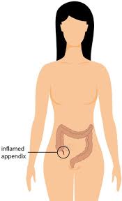You could link back the tutorial when you use it. Appendicitis Center For Young Women S Health