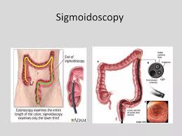 Image result for Colonoscopy in GI Bleeding