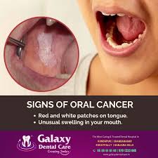 Image result for white cancer on tongue)