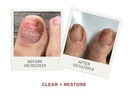 Artificial nails come in two main kinds: Fingernail Toenail Fungus Treatment Over The Counter Dr Kline Green