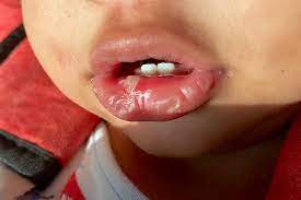 4 Effective Treatments To Cure Baby S Mouth Ulcers