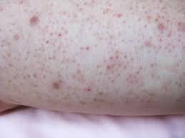 Image result for liver spots on legs
