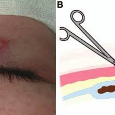 A nonoperative approach to subcutaneous removal of stubborn sutures from wound granulomas. Cutaneous Findings Showed A A Chalazion Like Suture Granuloma Arrow Download Scientific Diagram