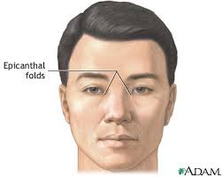 Epicanthal fold, epicanthus, eye fold,2 mongoloid fold,3 palpebronasal fold4. Common Syndromes Pdf Free Pdf Epub Medical Books