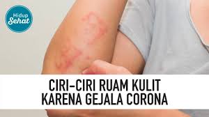 Gejala lainnya yang lebih jarang dan mungkin dialami beberapa pasien meliputi rasa nyeri dan sakit, hidung tersumbat, sakit kepala, konjungtivitis, sakit tenggorokan, diare, kehilangan indera rasa atau. Dokter Kulit Kupas Tuntas Soal Bedanya Ruam Gejala Corona Vs Ruam Biasa Lifestyleone Tvone