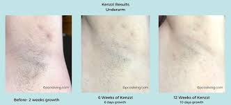 With many other forms of hair removal, including waxing, plucking, shaving and hair removal cream, the hair will return quickly, often within a matter of days. Laser Hair Removal For Pcos Kenzzi Review Pcos Living