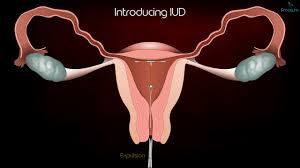 It's a small piece of there are 5 different brands of iuds that are fda approved for use in the united states: Intrauterine Device Iud Copper T Removal Procedure Patient Education Medical Animation Youtube