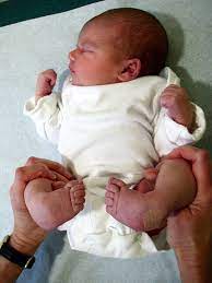 Learn more from boston children's hospital. How Parents And The Internet Transformed Clubfoot Treatment Shots Health News Npr